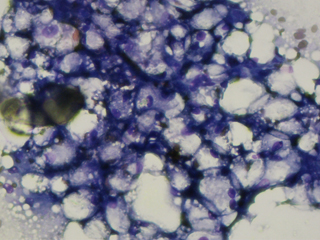 図：白い空胞を持った肝細胞（脂肪変性）